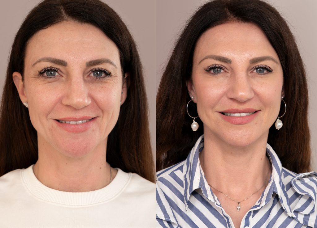 Before i after front insta size a