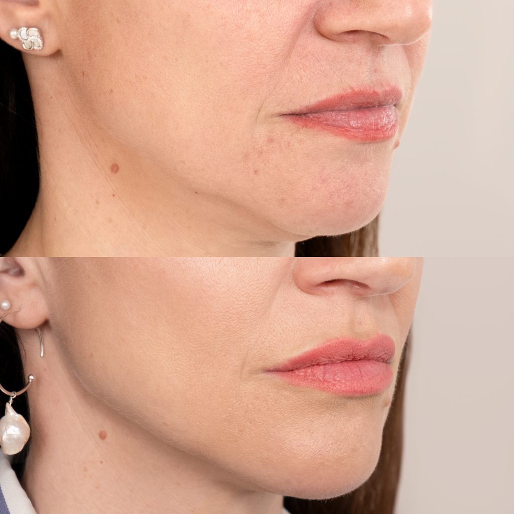 Close up before after 1 insta size