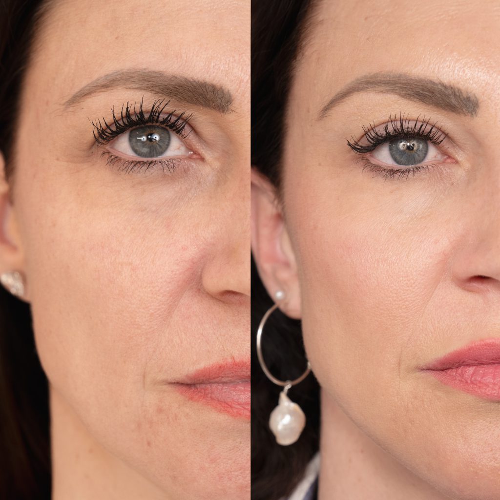 Close up before after 2 insta size